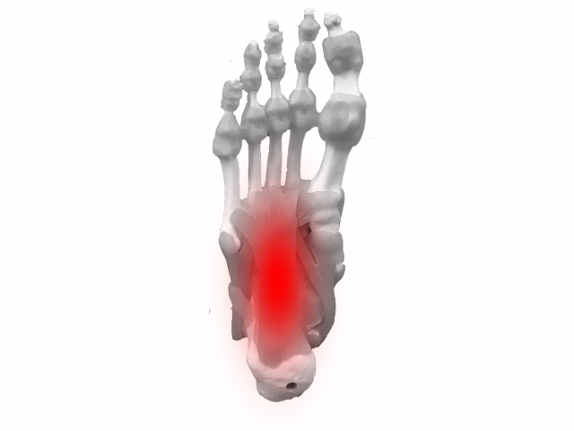 前橋市在住の40代女性の足底腱膜炎