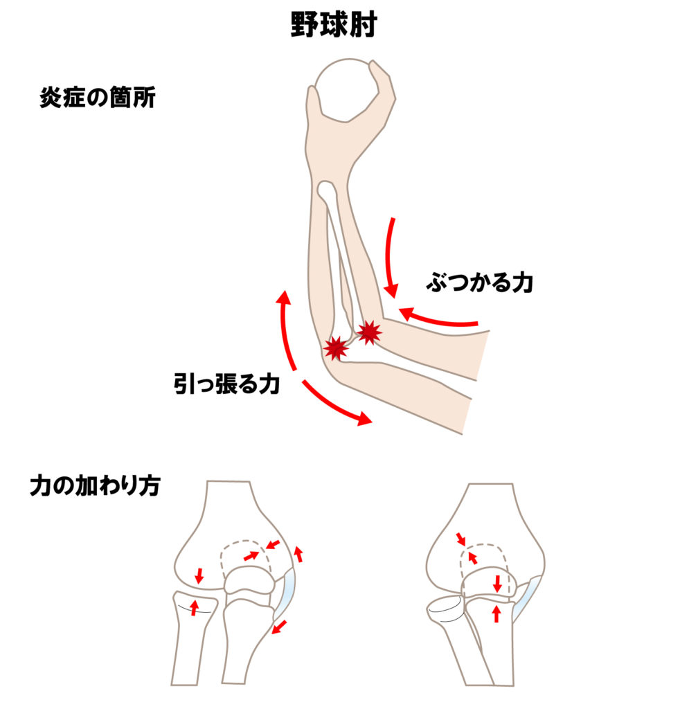投げるときに負荷がかかる場所